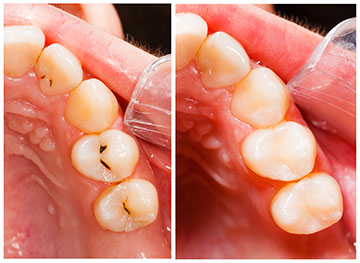 Tooth Colored Fillings Teeth